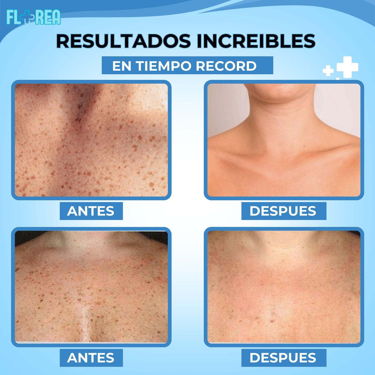 1 + 1 GRATIS LUMICLEAR™ CREMA TRIPLE ACCIÓN CON VITAMINA CPARA LA ELIMINACION DE PECAS Y MANCHAS DE LA PIEL